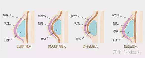 隆胸后手感会变差吗?