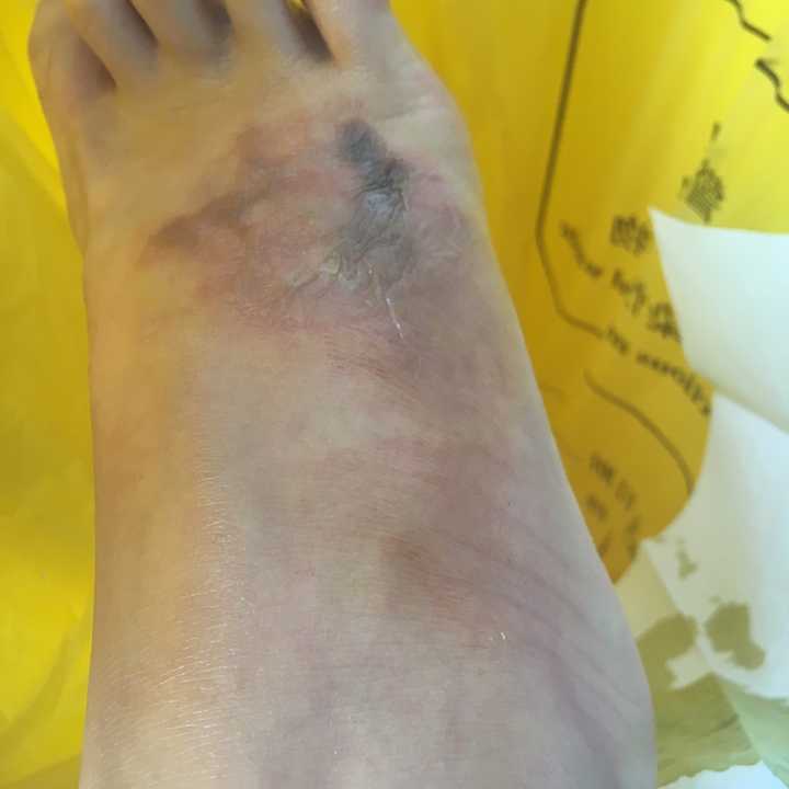 烫伤之后怎么做不会留下疤痕?