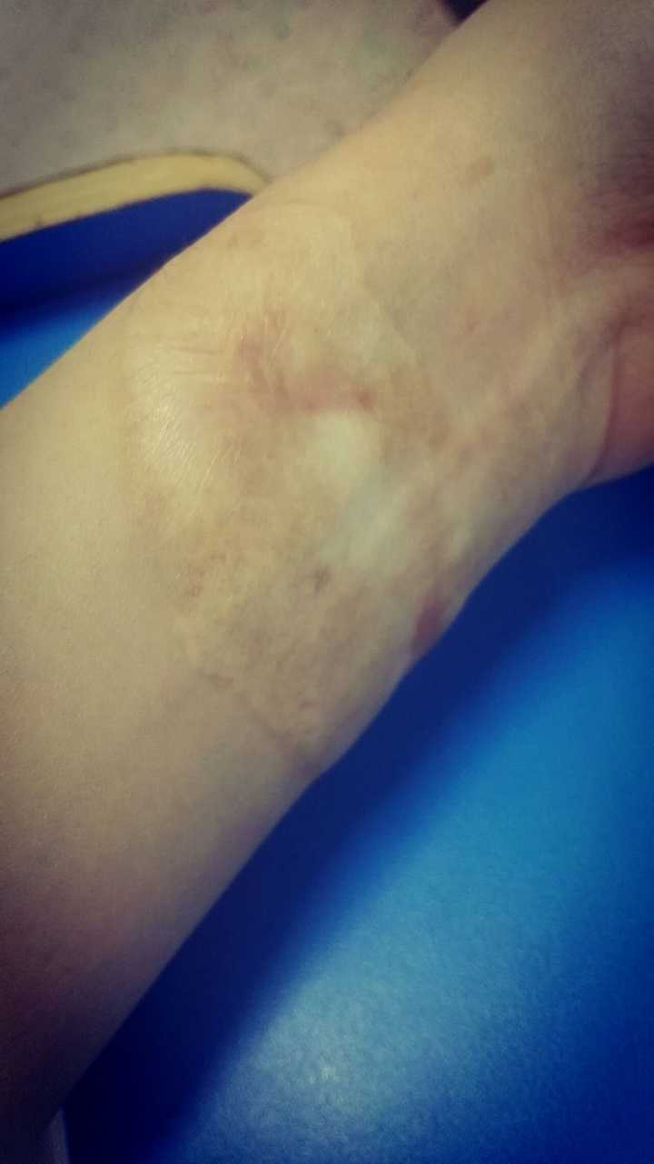 男性是如何看待女性的疤痕的?