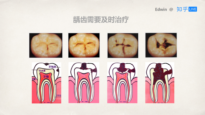 蛀牙的发展过程(窝沟龋 1【氟】