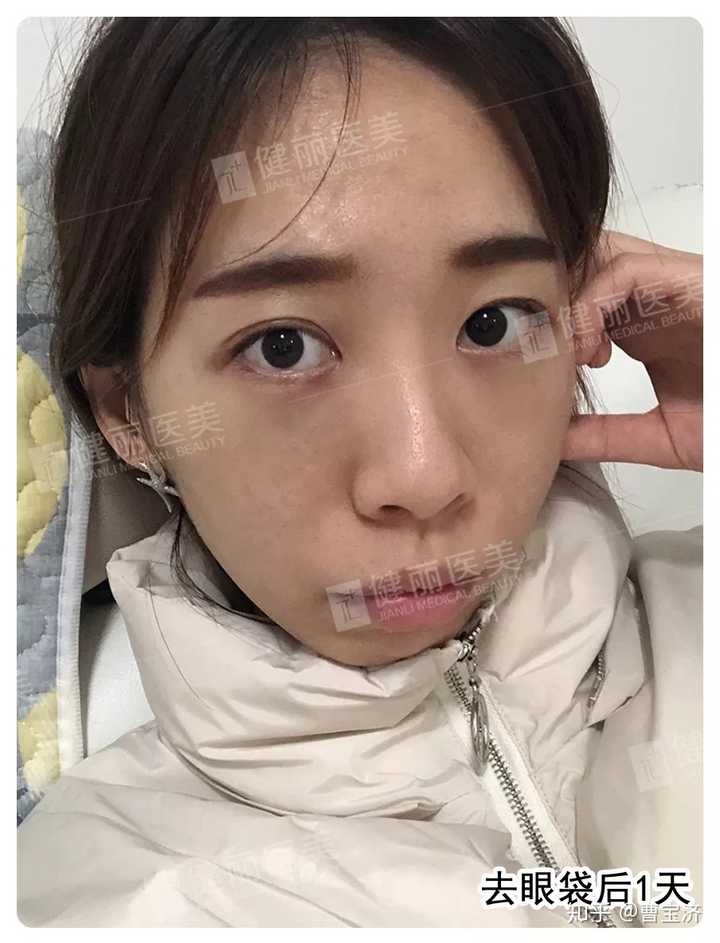 割完双眼皮后眼袋为什么重了?还能恢复吗?