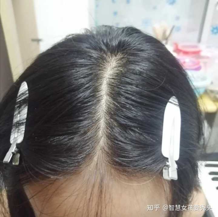 这些不好的生活习惯都会使你脾虚气血不足的,然后头发就会变的很油腻