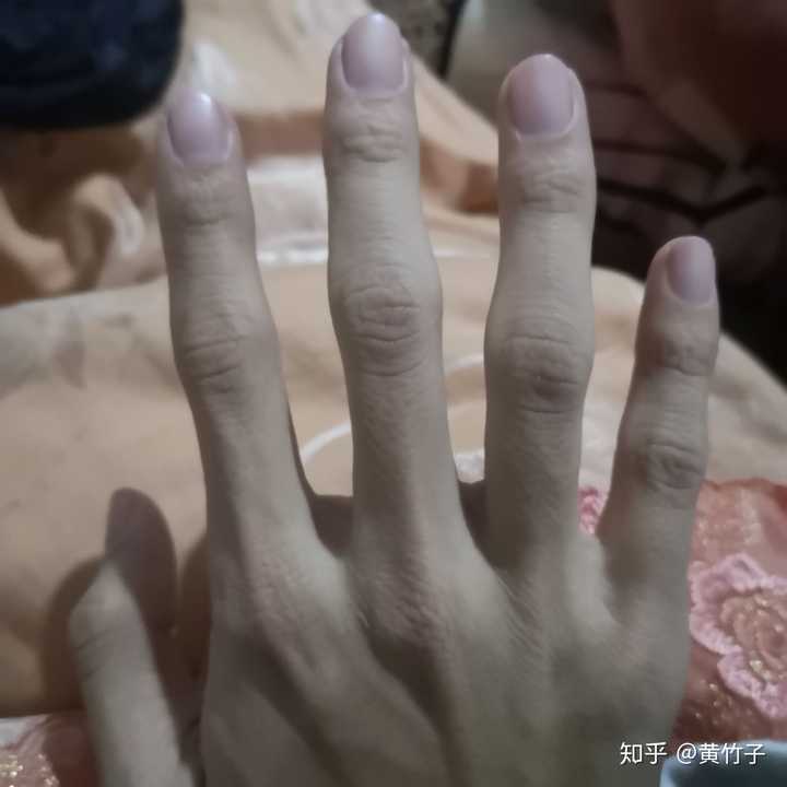 这是手指歪了嘛?能否矫正?
