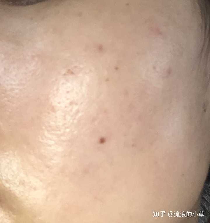 请问,有哪位朋友用过他扎罗汀乳膏,祛痘坑真的有用吗?