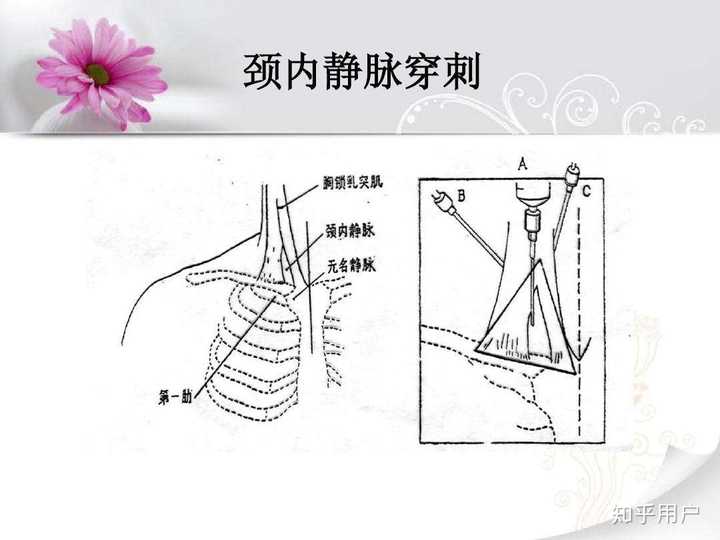 颈静脉穿刺技巧?