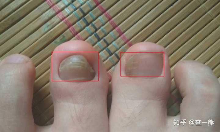 根据症状图片判断,你是属于真菌感染引起的灰指甲,症状表现为甲萎缩