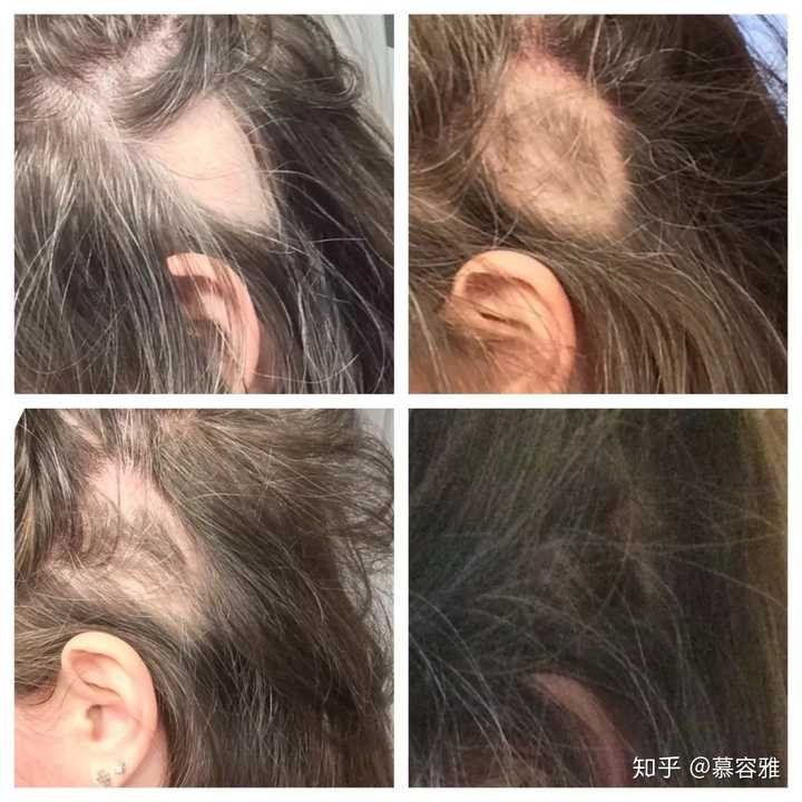 我想知道有二十刚出头女生被"鬼剃头"(医学上叫斑