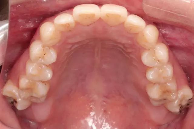 且从内部图来看,上牙牙齿拥挤,导致后牙无法咬合且外突.