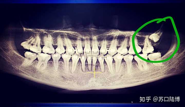 x光片检查后发现,左上第三磨牙为低位阻生