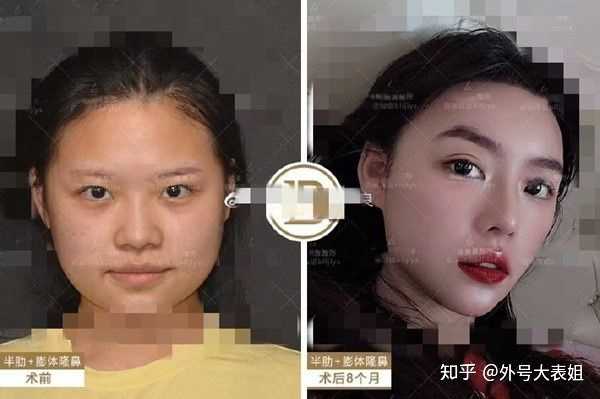 鼻基底宽大