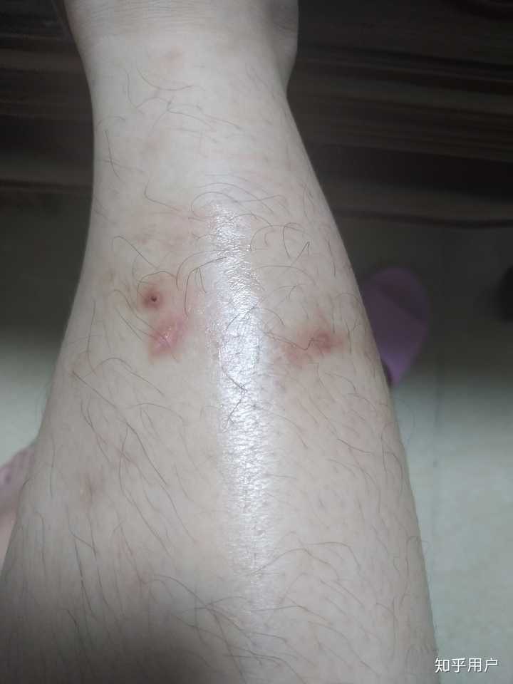 被蚊子咬你们用什么药膏