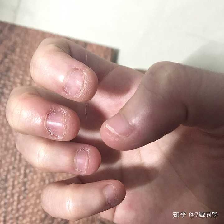 停止啃指甲之后,指甲能不能恢复正常?