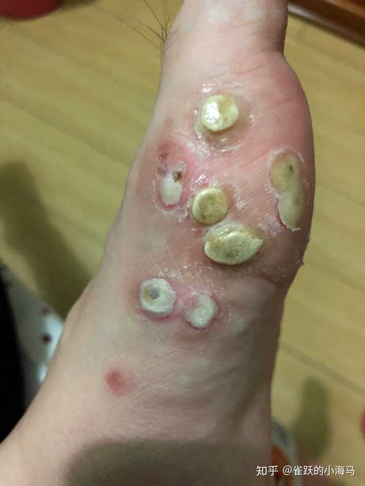 患过趾疣的进,大家说说自己的书怎么治好的 ?