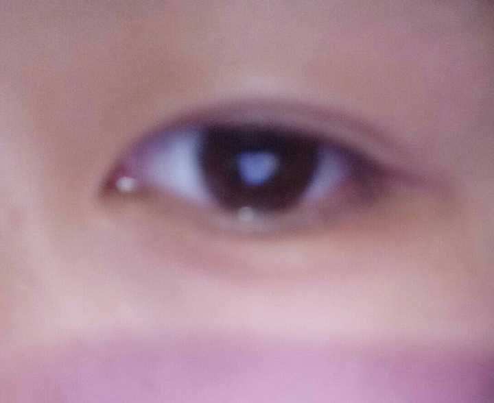 怎么从单眼皮自然变成双眼皮?
