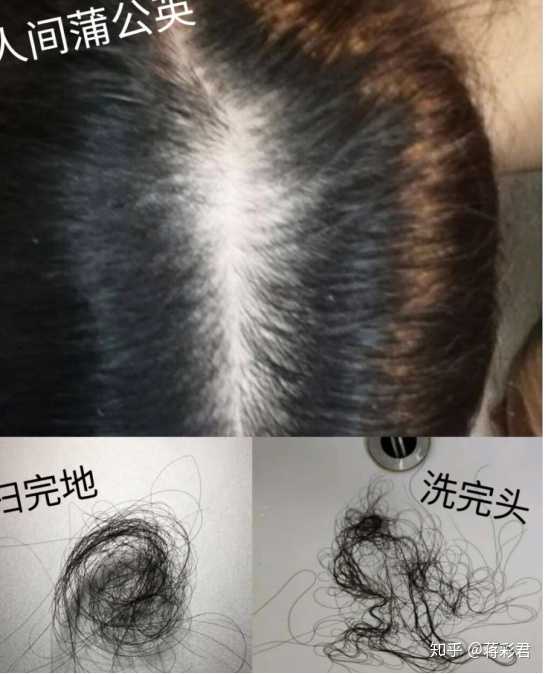 女性脂溢性脱发该怎么治疗?