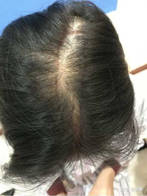 女生秃顶是怎样一种体验?
