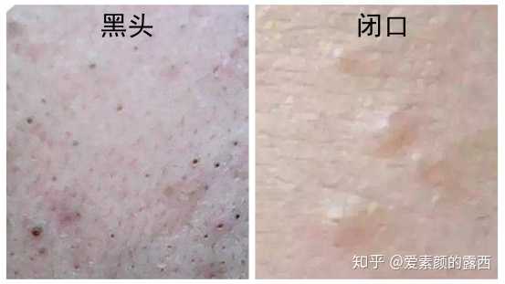 长痘痘,痤疮的皮肤适合用什么洗面奶和护肤品?