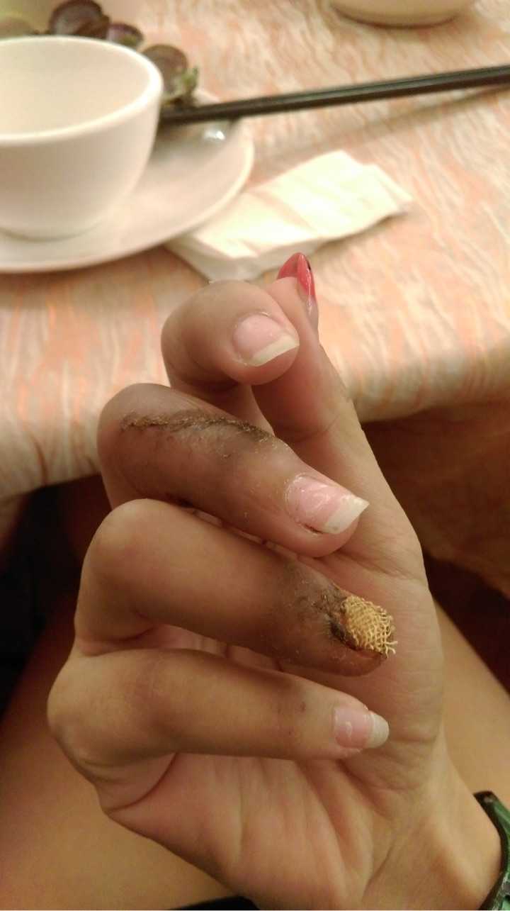 手指头骨折是种怎样的体验?