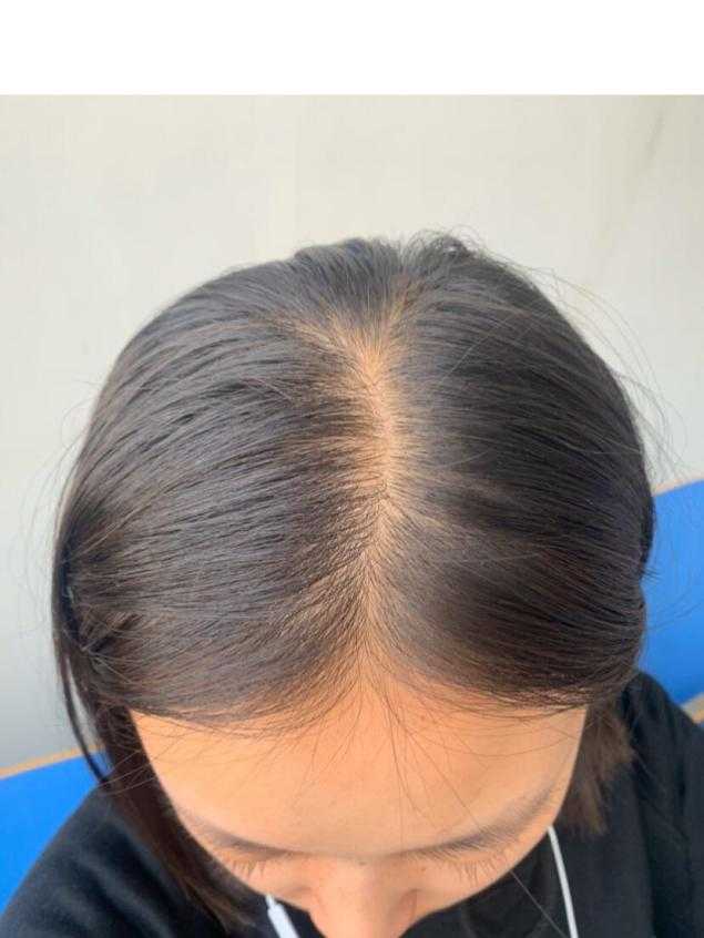 救救孩子,细软发质怎么防脱发?