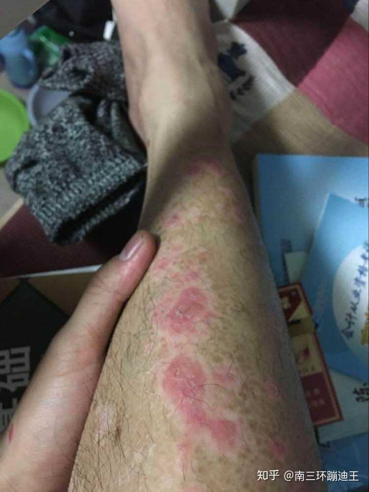 大三学生 大一患了牛皮癣 本该是大好青春 从得病那一天就结束了