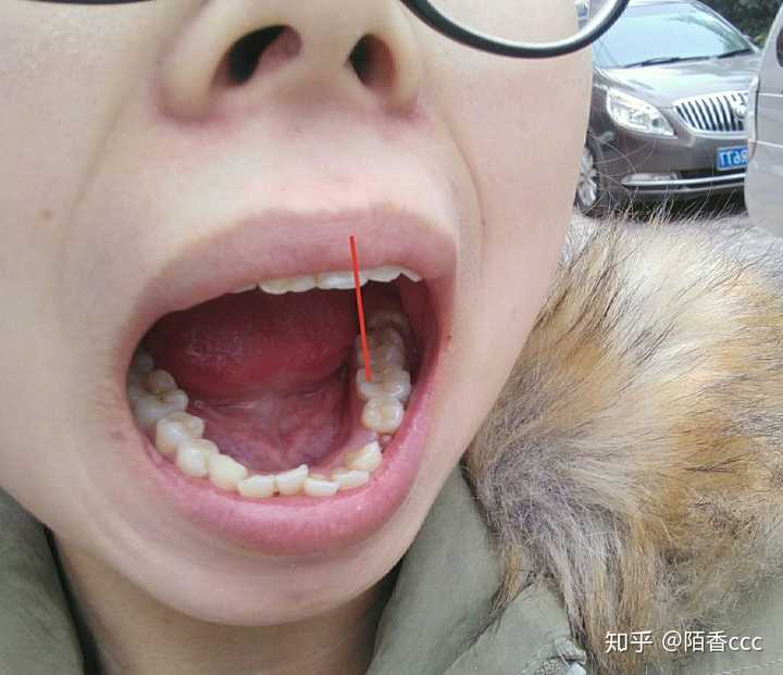根管治疗后补的牙,和旁边的牙没有太大区别,还挺好看的.