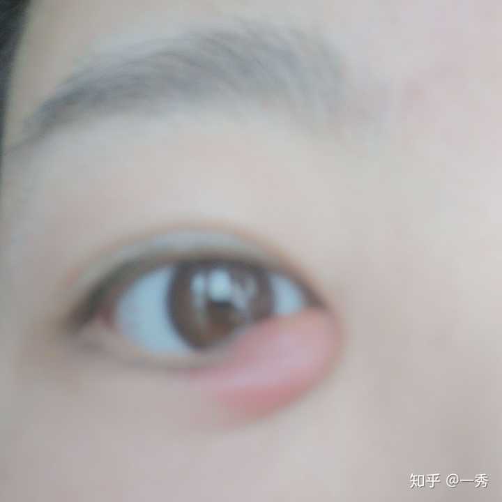 有起过内麦粒肿的吗?你们都是怎么治好的呢?