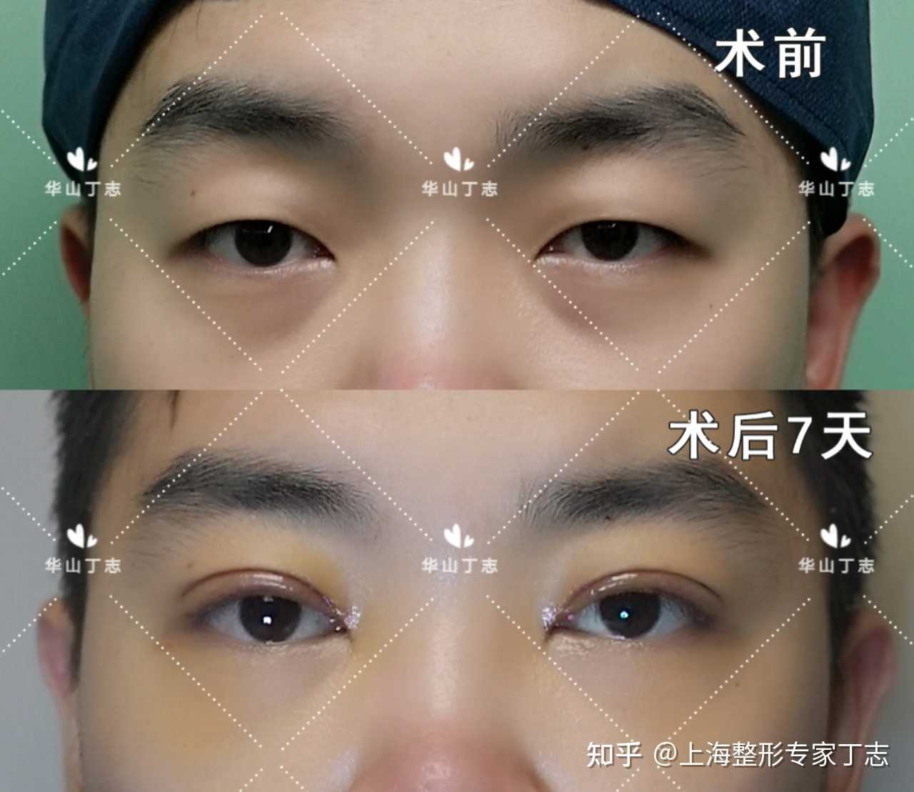 上海整形专家丁志 的想法【男生全切双眼皮术后第7天 从美学角度