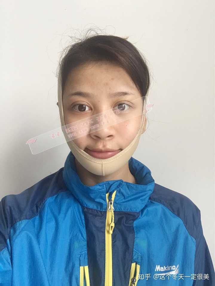 磨骨后1个月的照片,完全消肿了