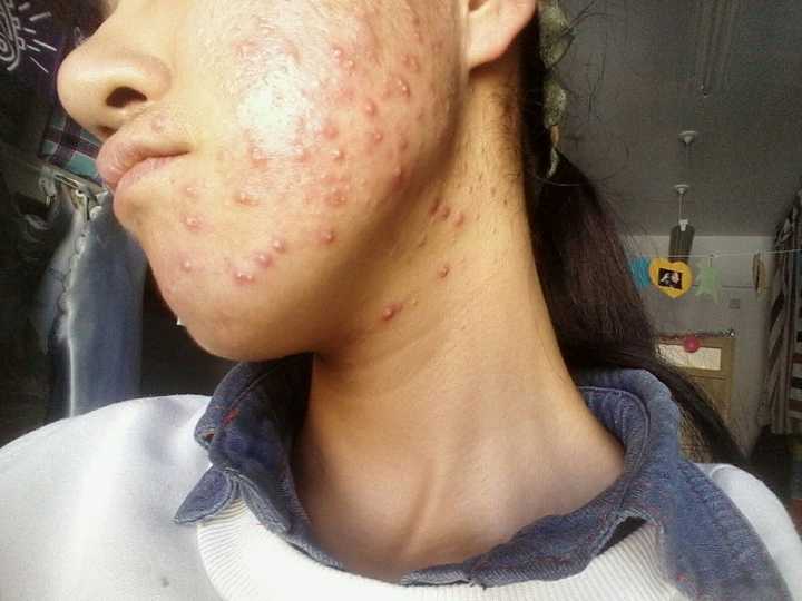 长痘(痤疮)是怎样一种体验?