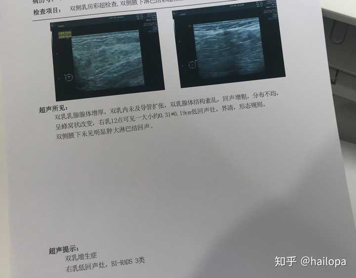 乳腺超声检查报告bi-rads 3级的女人们,你们几岁发现的,目前是良性的