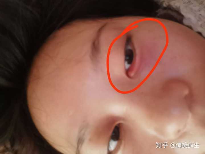 有没有得过外麦粒肿的朋友,怎么个痊愈过程.