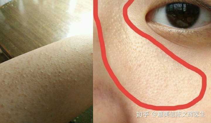 毛周角化是什么样子的?