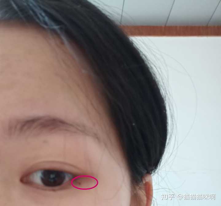 如何辨别泪痣?