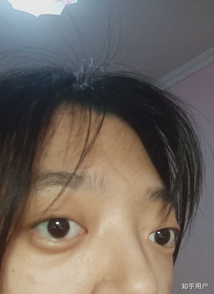 眼睛太凸怎么办?