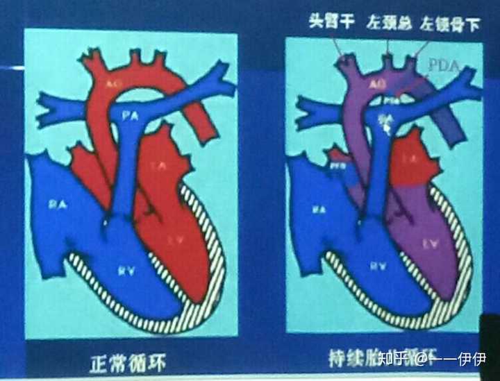 新生儿是如何重建血液循环的?