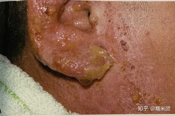 「湿疹」这一疾病有何病因,如何预防与治疗?