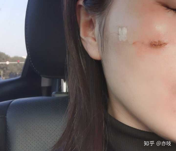 不小心摔倒磕到脸上了,立马去九院用美容针缝合的.