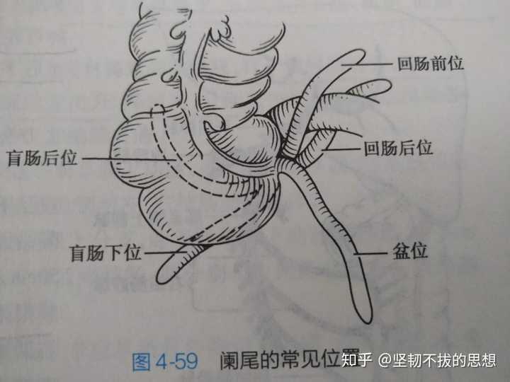 也就是说,并非是所有的阑尾都长在上图的"麦氏点"位置.