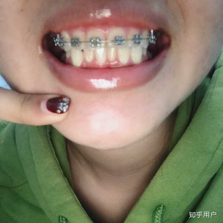 戴过牙套矫正牙齿的人脸型变了吗