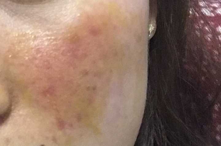 这是另一边脸.看着还挺吓人的