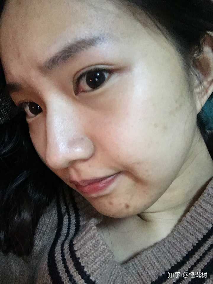怎么看待五官漂亮但是皮肤差的女性?