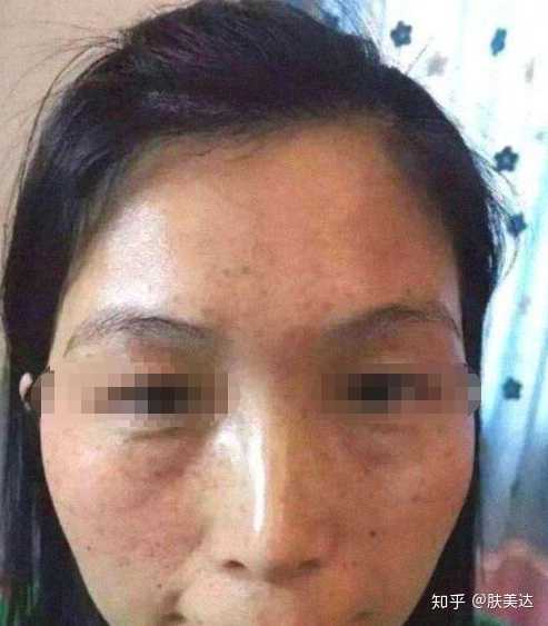 如何有效控制黑色素的增多?