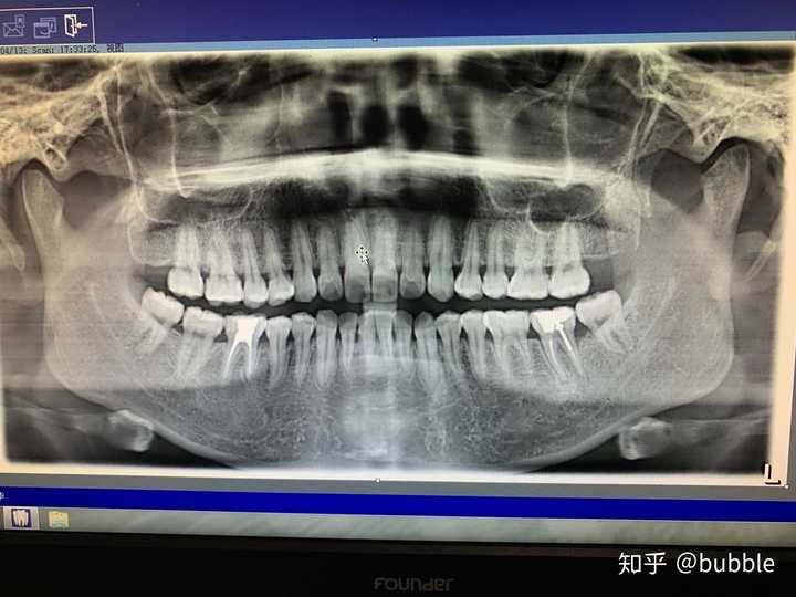 今天去拔了那颗坏牙,那个黑的吖,不想看它 附上我牙的ct检查图片 嗯