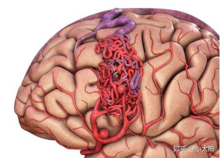脑动静脉畸形示意图(红色为动脉/蓝色为静脉)