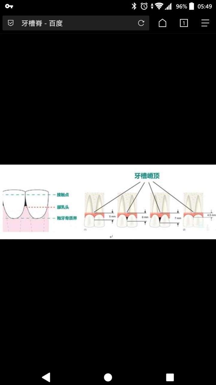 牙槽骨(alveolarbone)是上,下颌骨包围和支持牙根的部分,又称为牙槽突