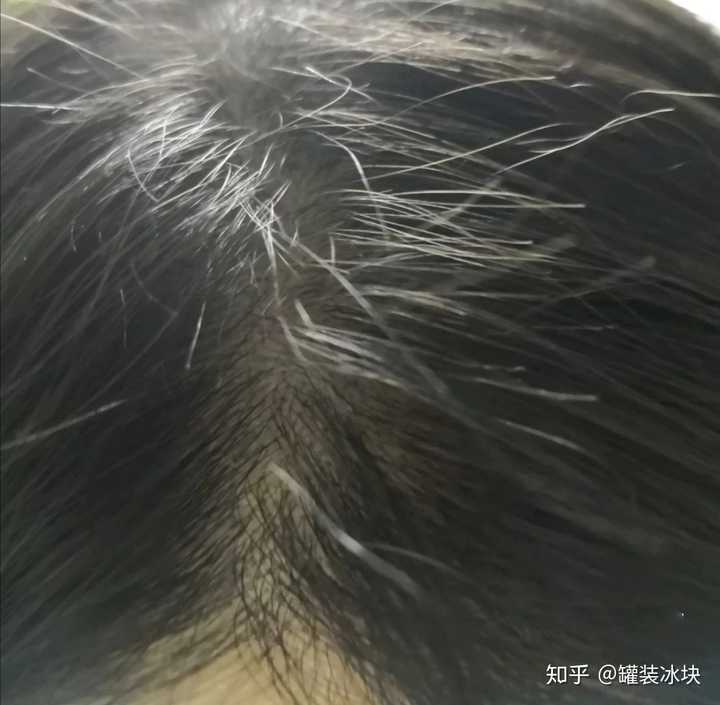 用了米诺地尔快一个月了,每天洗头能掉100根左右,很慌张,而且也不确定