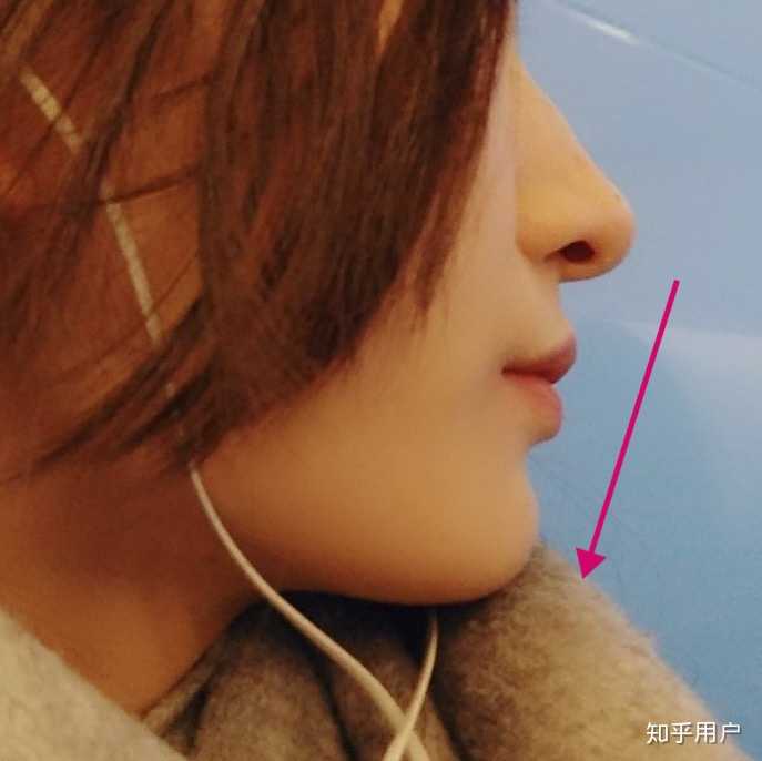 戴牙套后 鼻尖下巴嘴唇基本成直线,我还是觉得稍微有嘴突,下巴平天生