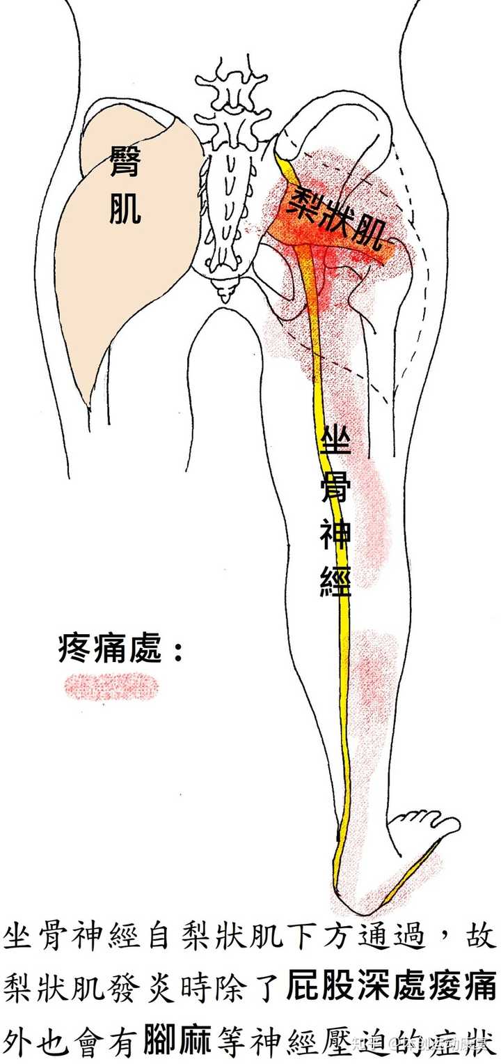 梨状肌综合征好痛苦啊!