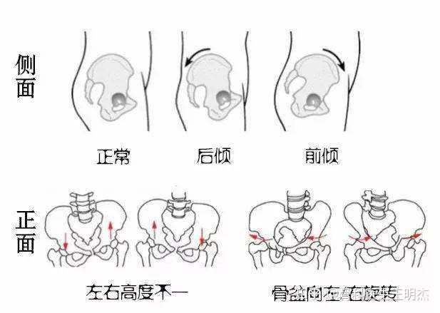 (1) 单侧或双侧骶髂关节及臀外上方疼痛, 且有压痛, 翻身疼痛加重
