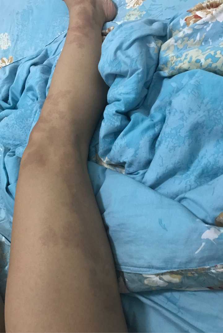 腿上有胎记夏天不能穿裙子怎么办?